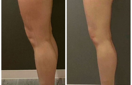 【1ヶ月で脚やせ】プロが「可能です」と断言する理由｜-5cmも夢じゃない”見た目激変”メソッド