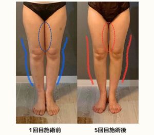 1ヶ月で脚のむくみとねじれを解消する短期集中メソッド