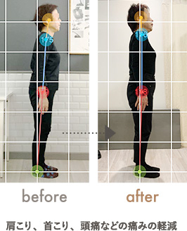 慢性的な肩こり・頭痛の改善