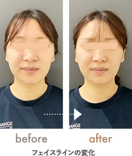 フェイスライン・食いしばりの改善
