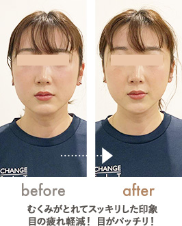 顔のむくみ・眼精疲労の改善