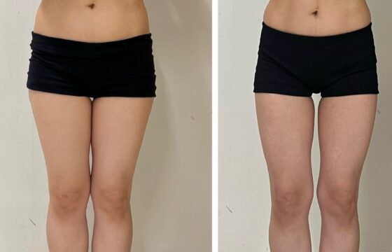 1ヶ月で脚やせメソッドを実践して太ももー3cmを達成した体験記