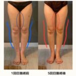1ヶ月で脚のむくみとねじれを解消する短期集中メソッド