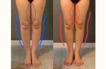 1ヶ月で脚のむくみとねじれを解消する短期集中メソッド