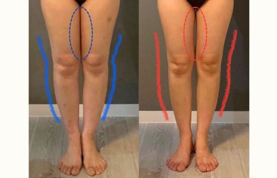 1ヶ月で脚のむくみとねじれを解消する短期集中メソッド